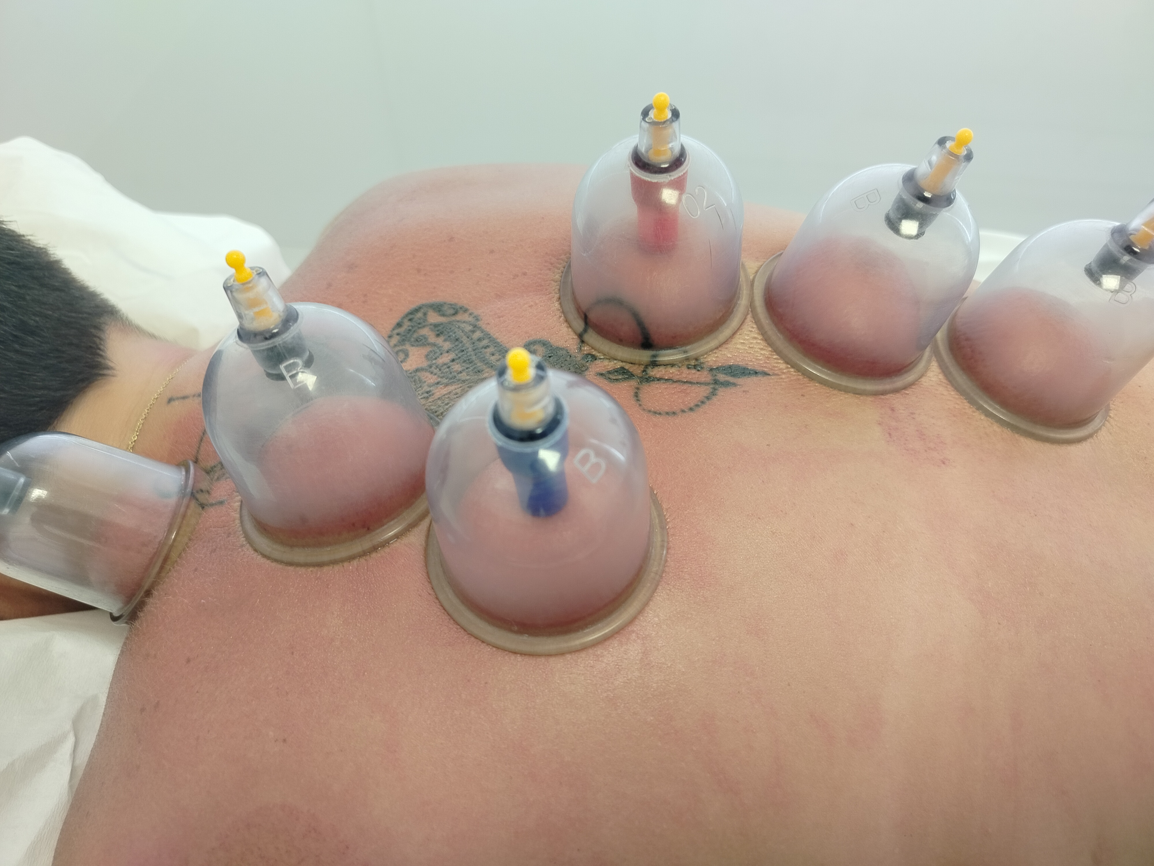 Cupping