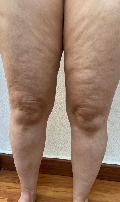 Lipedema management