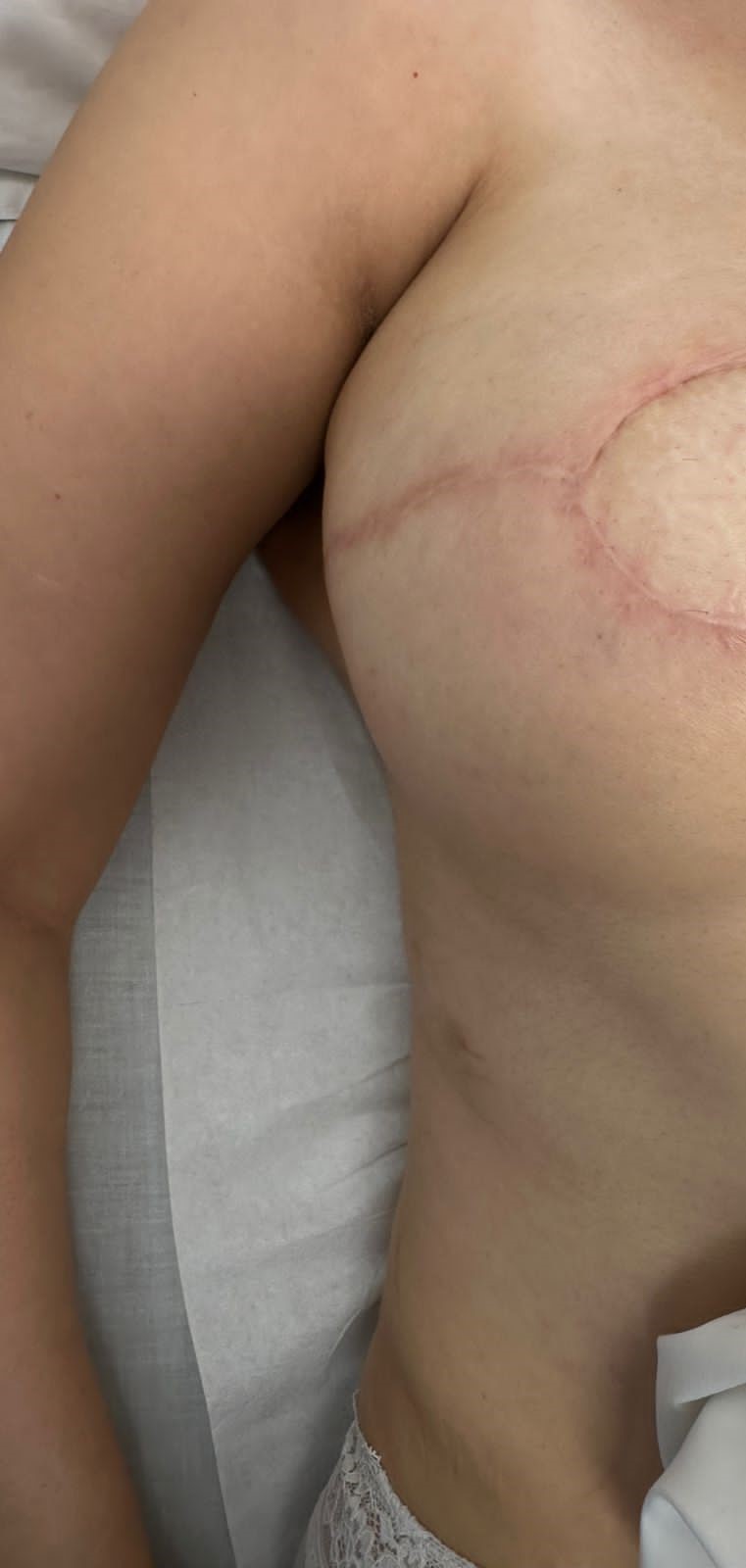 Breast Cancer Rehabilitation